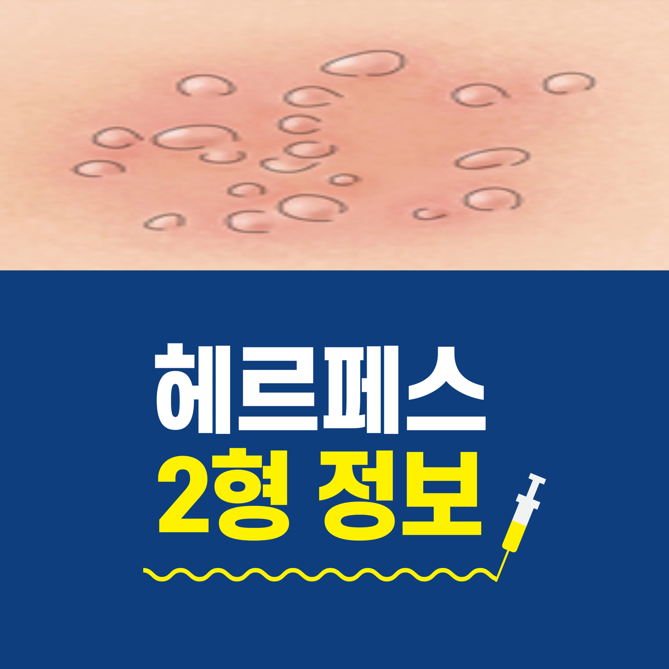 헤르페스 2형 증상 잠복기 전염 예방 전략 Ai 뉴스룸 9391