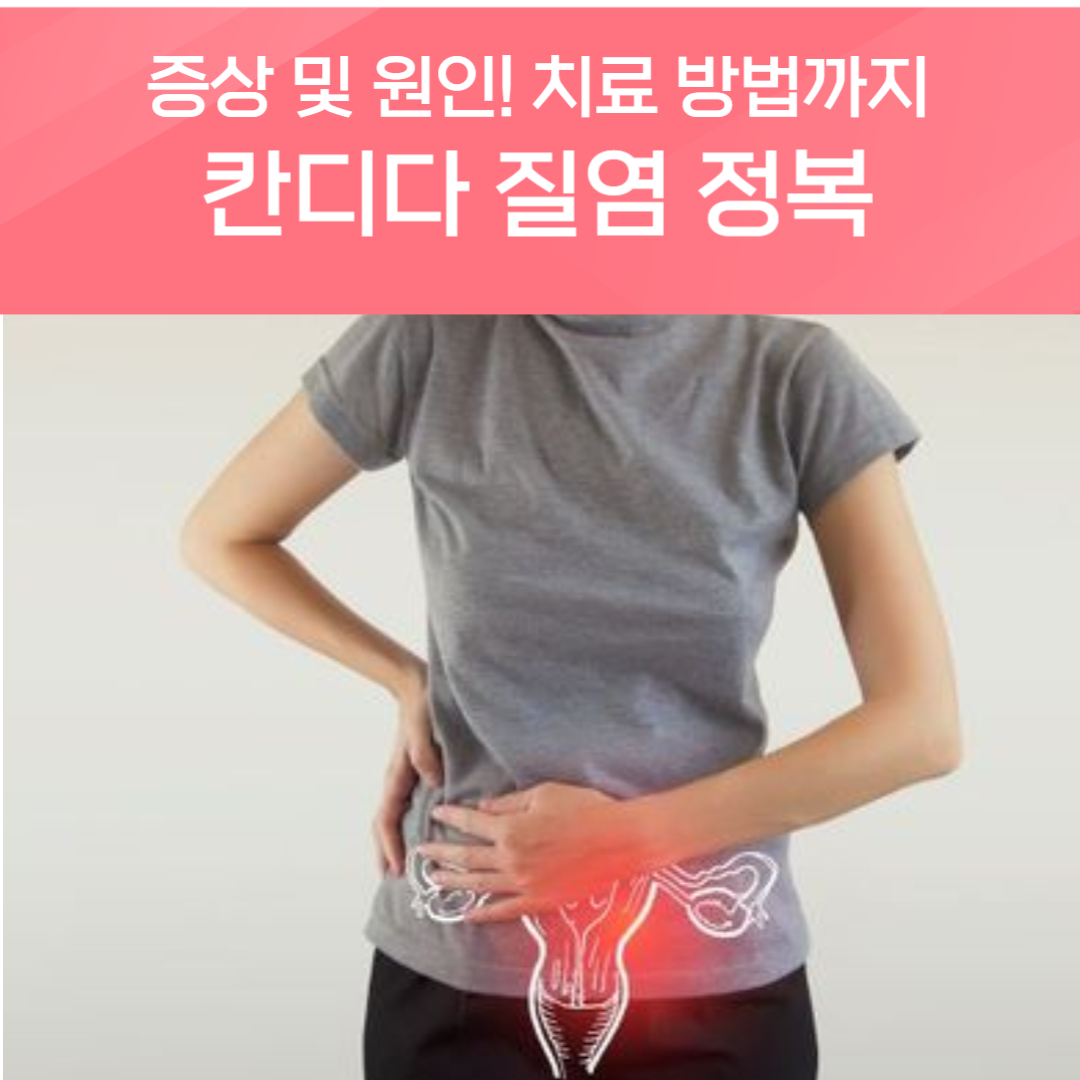 칸디다 질염 증상